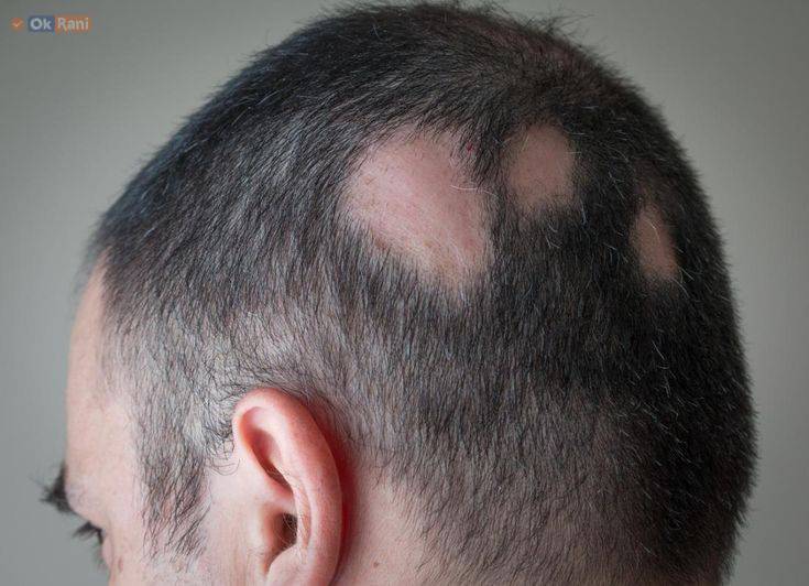 Alopecia Areata Hair Loss