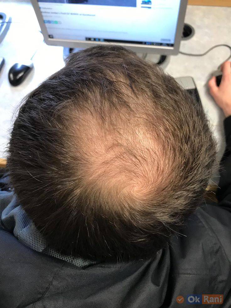 Androgenetic Alopecia Hair Loss
